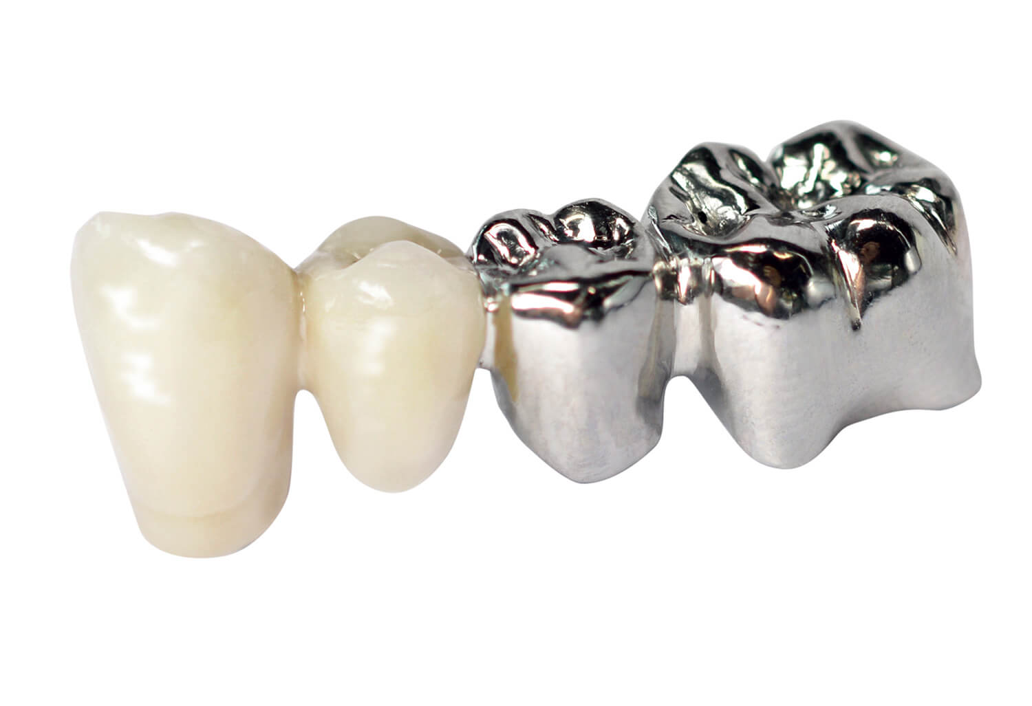 Couronne dentaire ceramo metallique