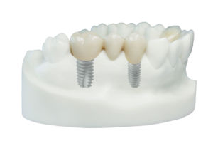 prothèse sur implant