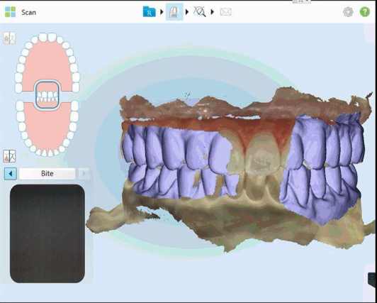 iTero : Scan du patient avec provisoire en bouche