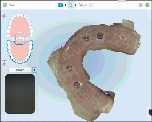 iTero : Scan du provisoire avec 3 analogues vissés dessus et muqueuse comme antagoniste
