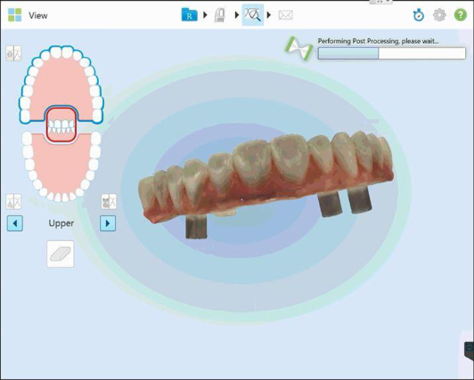 iTero : Scan du provisoire avec 3 analogues vissés dessus et muqueuse comme antagoniste