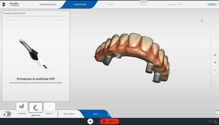 Protocole de scannage Cerec - Partie C étape 4 Cerec : Sur le provisoire, hors bouche, vissez-y 3 analogues et réalisez le scan de l’ensemble