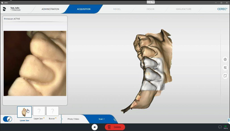 Protocole de scannage Cerec - Partie A étape 6 Cerec : Suivre les instructions à l’écran afin de passer à l’arcade du bas et scannez la mandibule