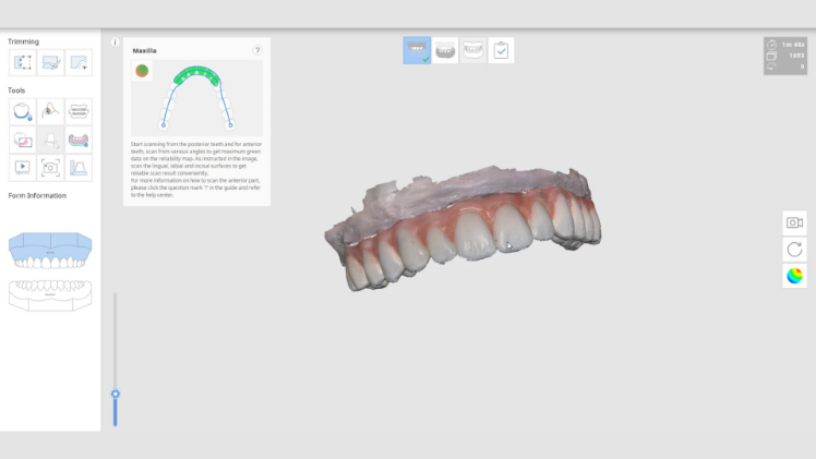 Protocole de scannage Medit - Partie A étape 1 Medit : Ouvrez Medit Link, créez un cas au nom du patient, sélectionnez « Modèle d’étude » pour le maxillaire/mandibule et lancez la partie scan. Scannez l’arcade avec le provisoire en bouche
