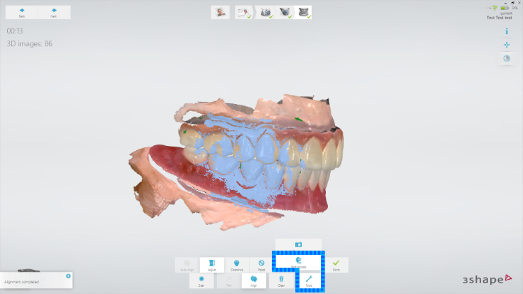 3Shape : Scan du patient avec provisoire en bouche