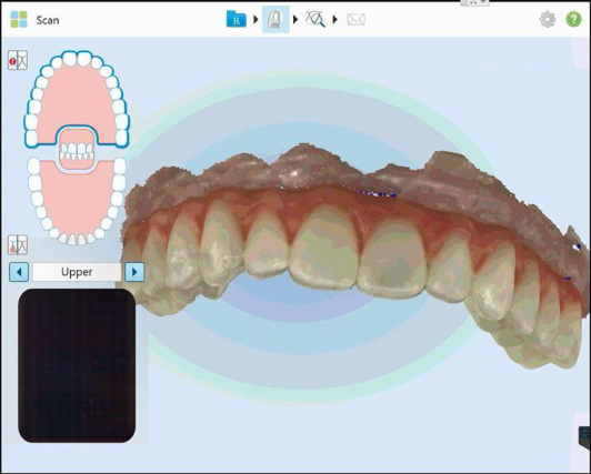 Protocole de scannage iTero - Partie A étape 5 iTero : Suivez sur l’écran les instructions pour réaliser le scan sur laquelle la prothèse sera réalisée