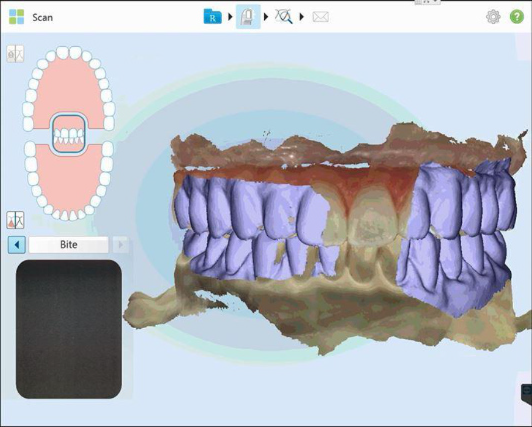 Protocole de scannage iTero - Partie A étape 7 iTero : Scannez l’occlusion. Assurez vous de bien scanner les 2 mordus