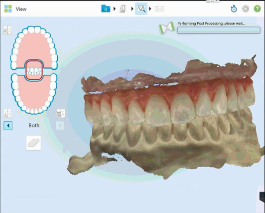 Protocole de scannage iTero - Partie A étape 8 iTero : Sélectionnez la fenêtre de post processing et confirmez que les données de scan sont correctes