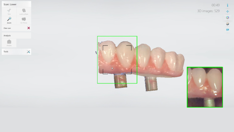 Protocole de scannage 3Shape - Partie C étape 6 3Shape : Scannez le complet provisoire, après y avoir vissé 3 analogues (indiquez la référence au laboratoire)