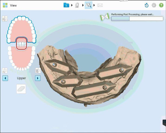 Protocole de scannage iTero - Partie B étape 5 iTero : Sélectionnez la fenêtre post processing et assurez vous que les données soient correctes